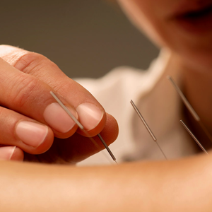 imgs_300x300px_acupuntura_saude_site_IDDEIA.png